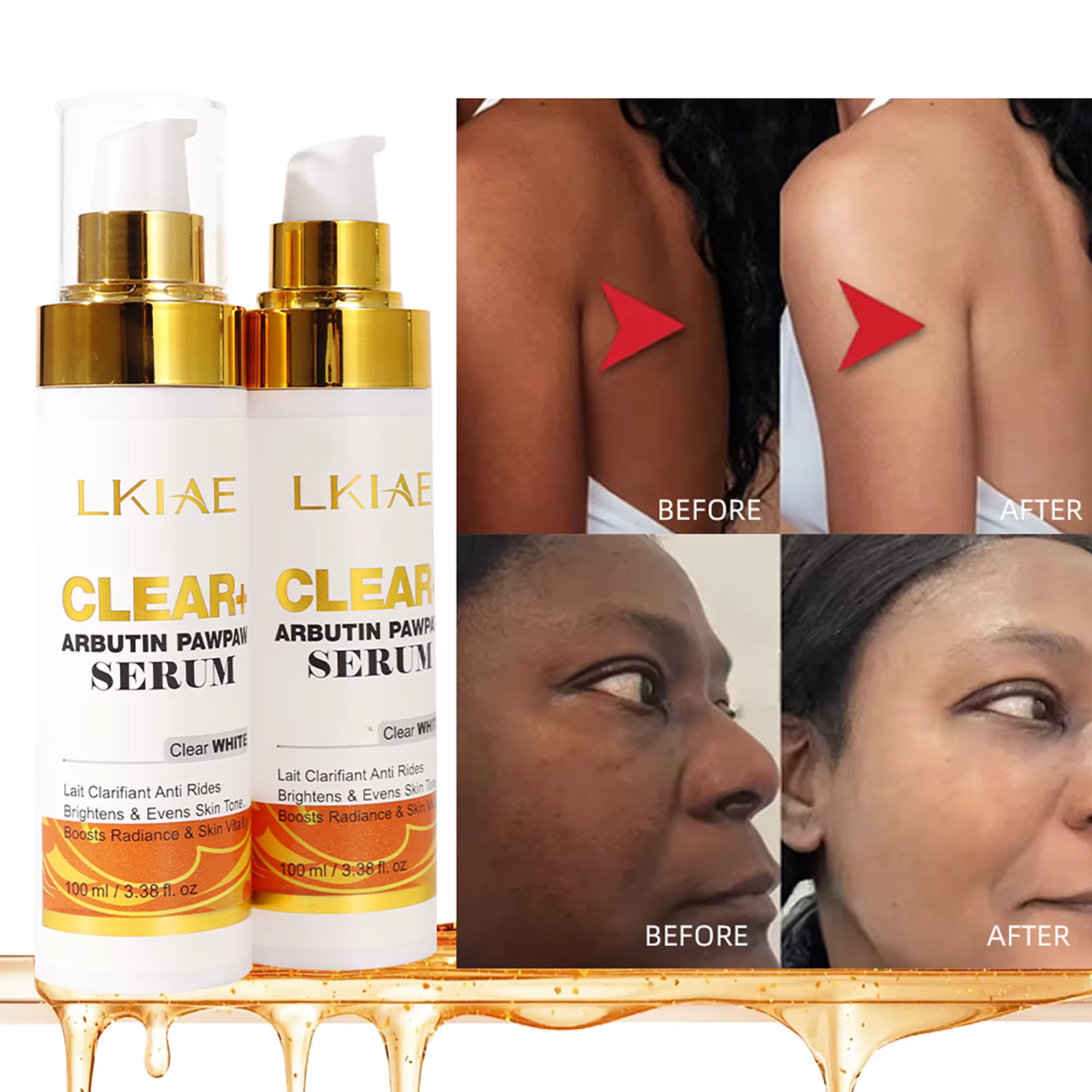 Sérum éclaircissant à l'arbutine LKIAE, hydratant, élimine les taches brunes, les points noirs, la m