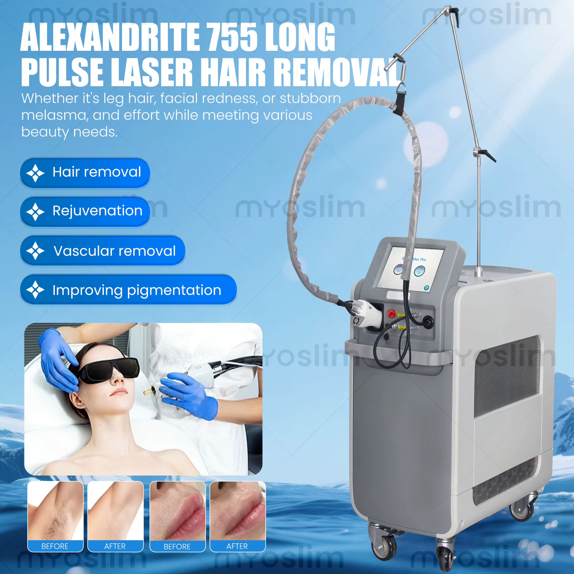 Machine laser Alexandrite professionnelle SLyric 755nm 1064nm | Épilation indolore et rajeunissement de la peau | Impulsion longue, haute puissance