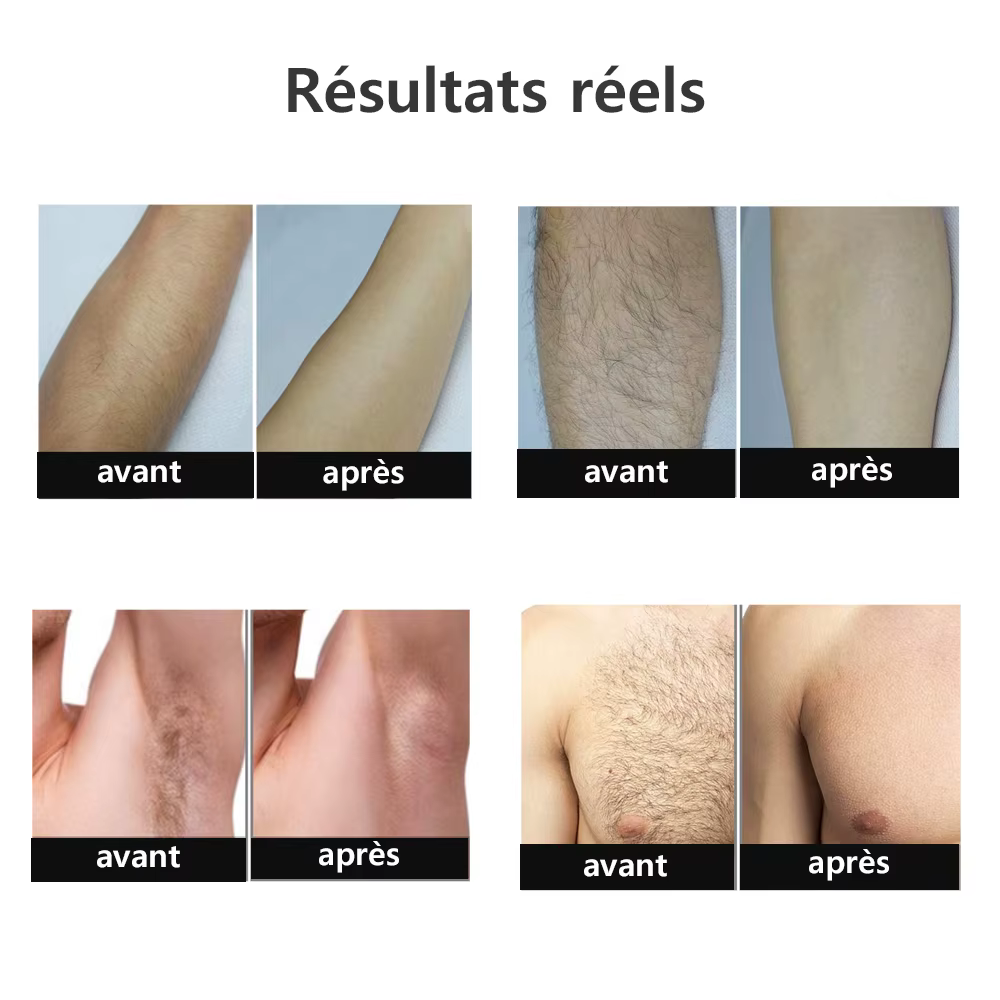 Depilador a laser ipl, remoção de pelos para mulheres