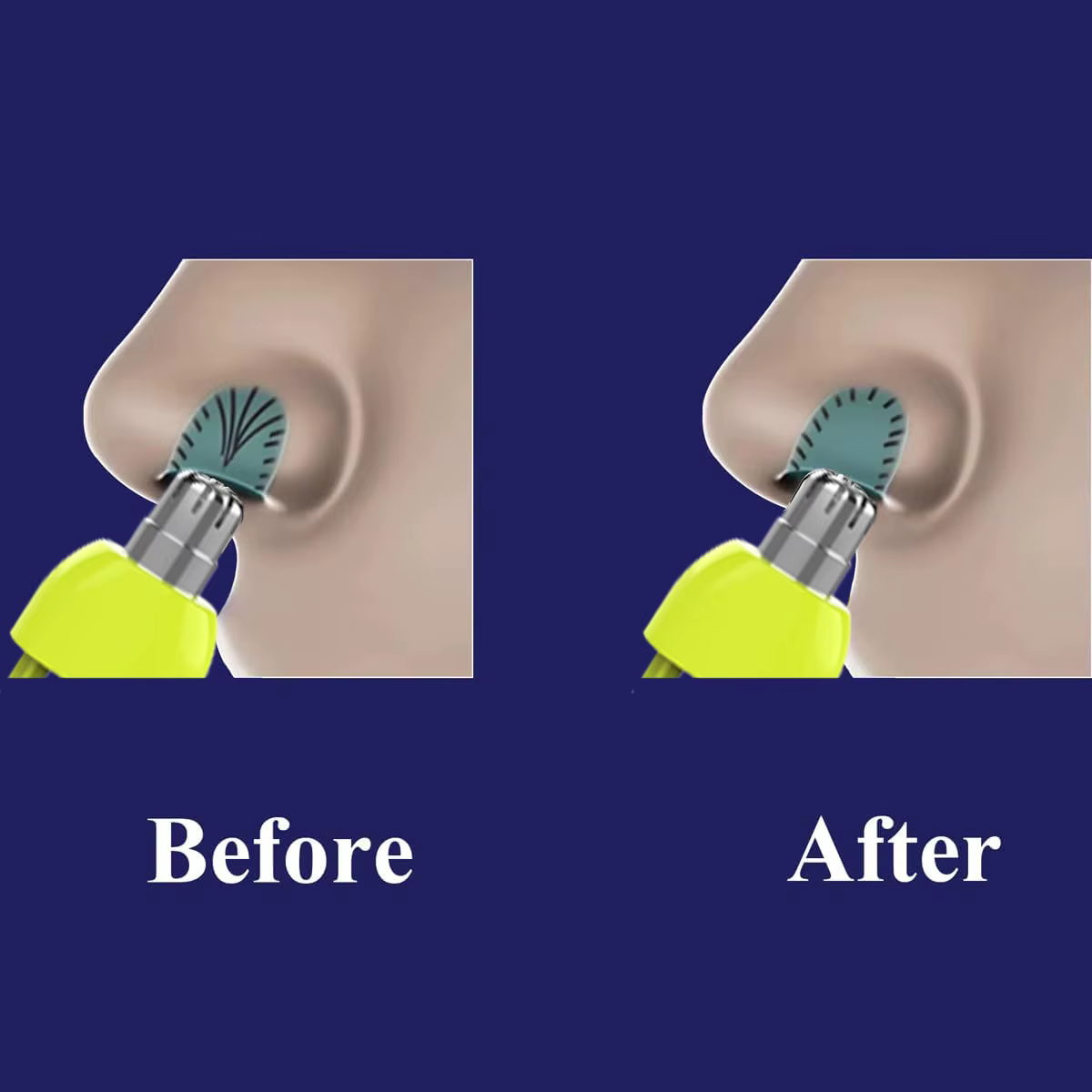 Têtes de rechange pour tondeuse à poils de nez Brangdy, pour rasoir Philips OneBlade QP2520 QP2630 QP6520 QP6530, lame à double tranchant lavable
